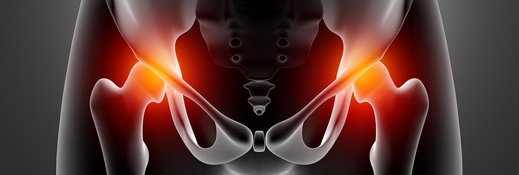 Hip Replacement image